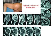spine cancer doctor in Gwalior